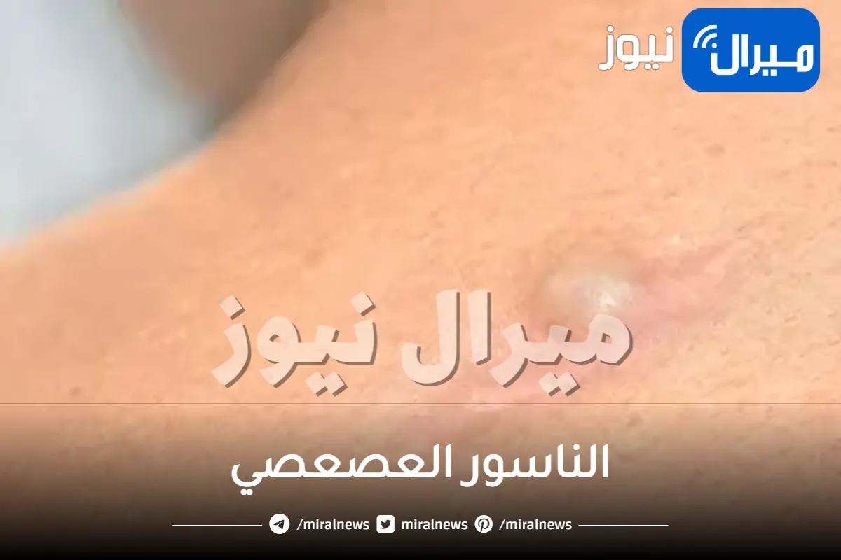 شكل الناسور العصعصي في بدايته