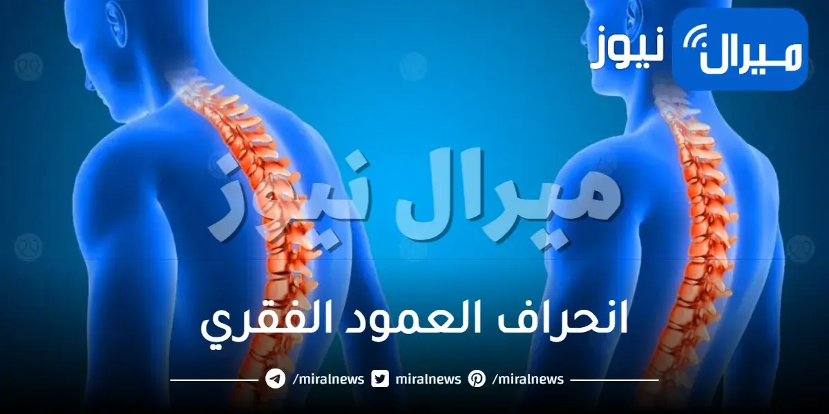 انحراف العمود الفقري