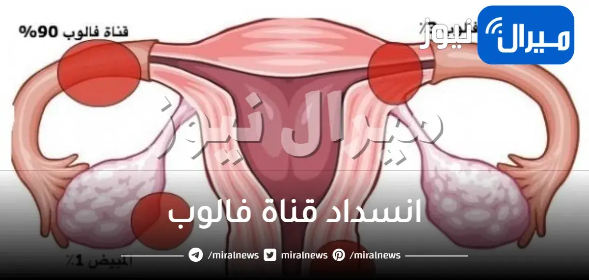 انسداد قناة فالوب