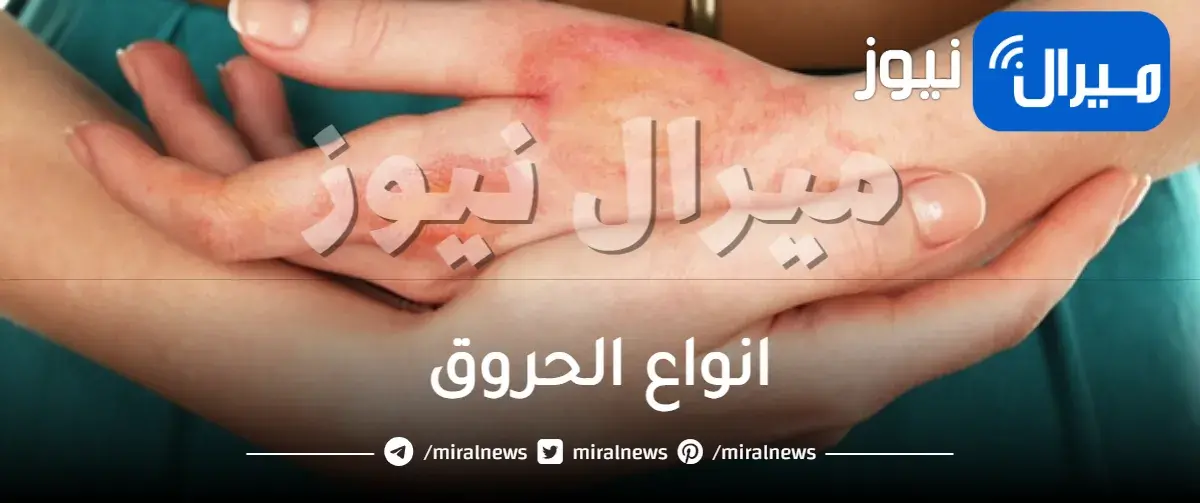 انواع الحروق