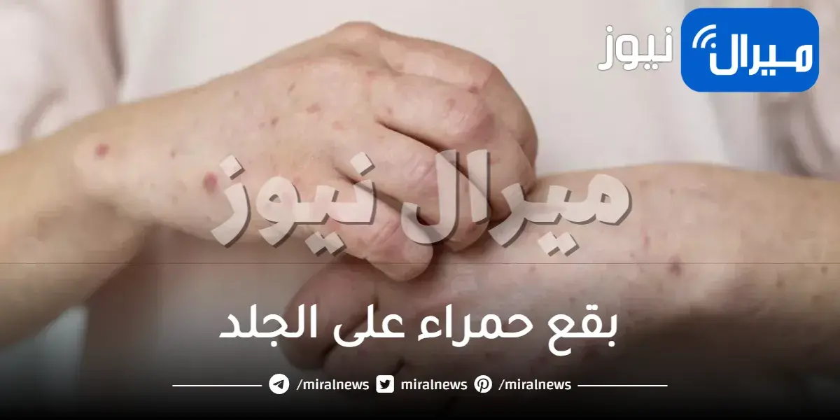 بقع حمراء على الجلد
