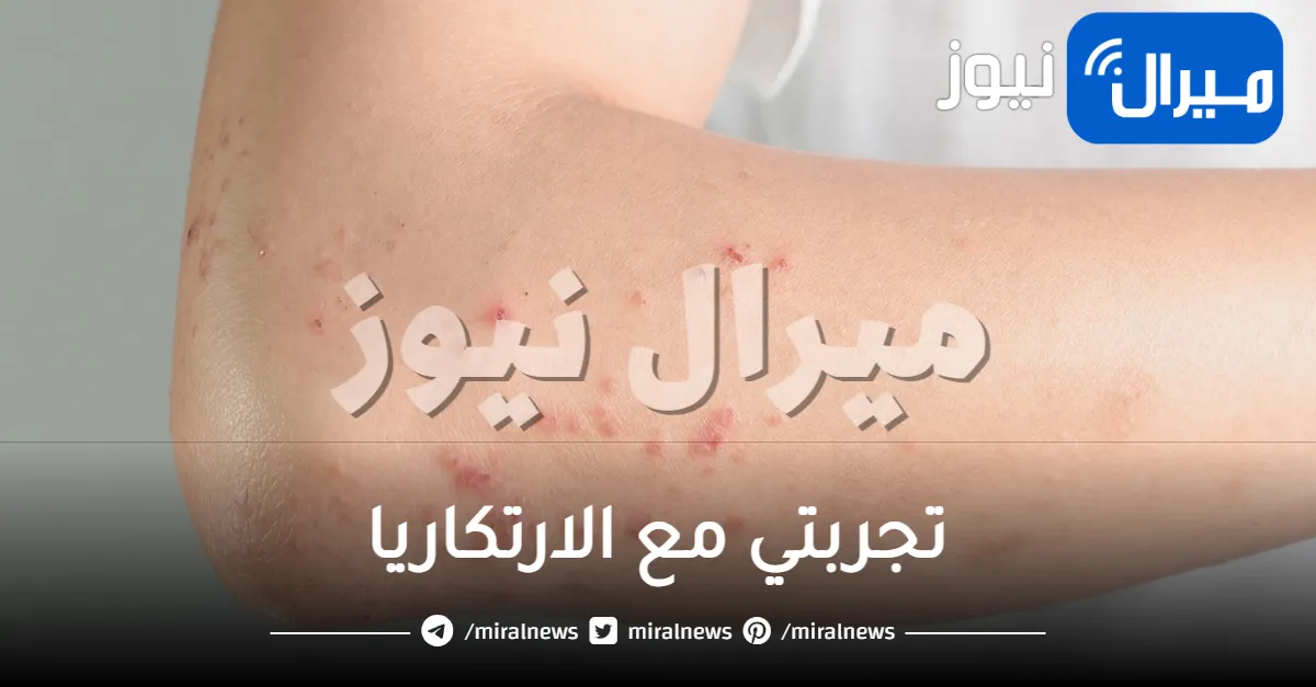 تجربتي مع الارتكاريا