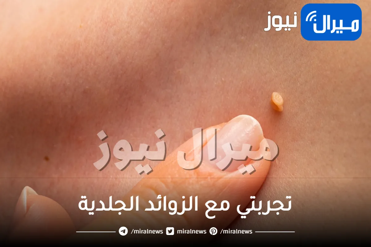 تجربتي مع الزوائد الجلدية