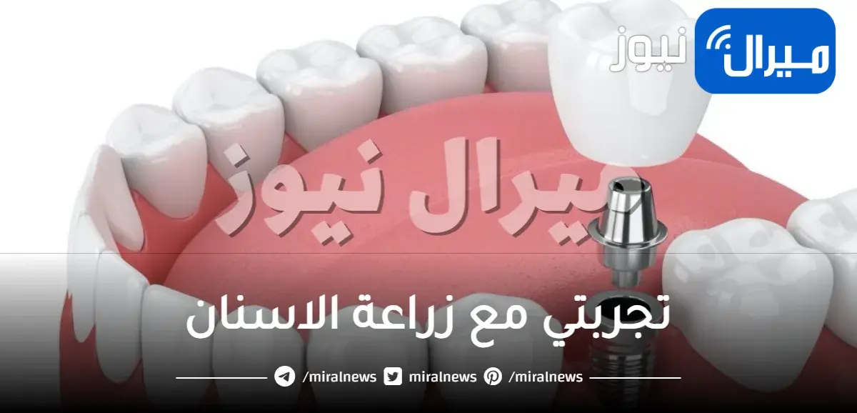 تجربتي مع زراعة الاسنان