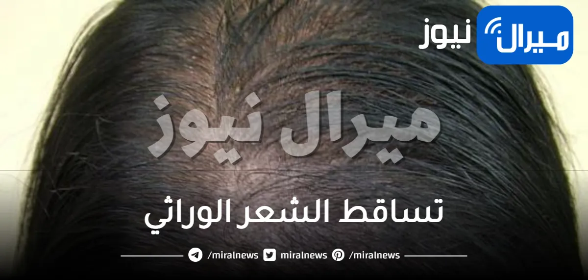 كيف اعرف تساقط الشعر الوراثي