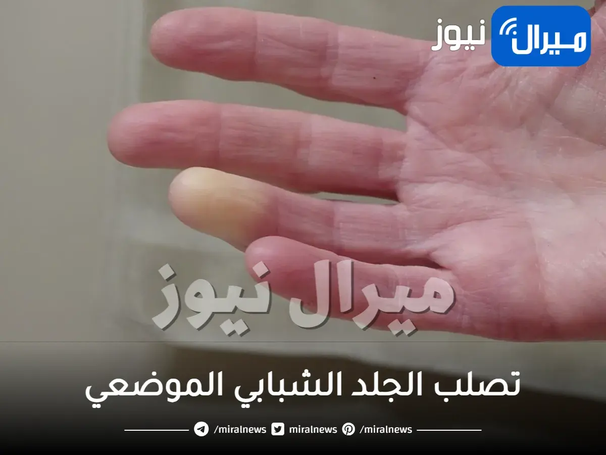 تصلب الجلد الشبابي الموضعي