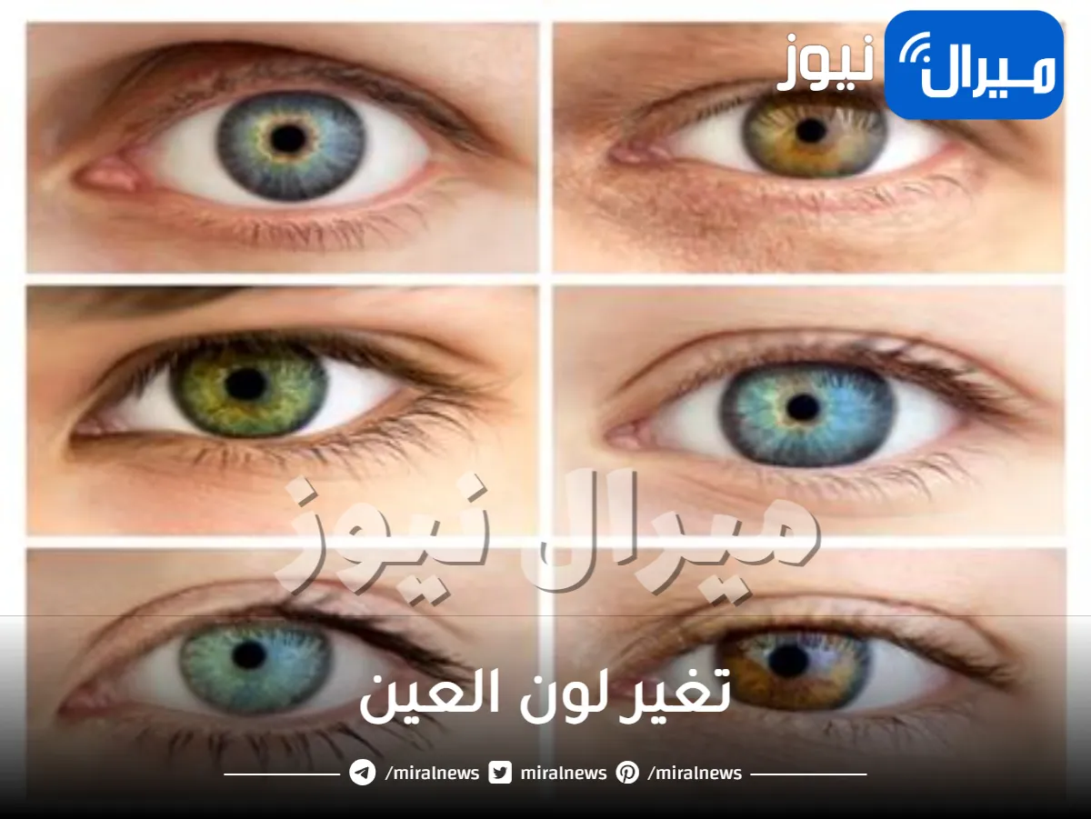 تغير لون العين