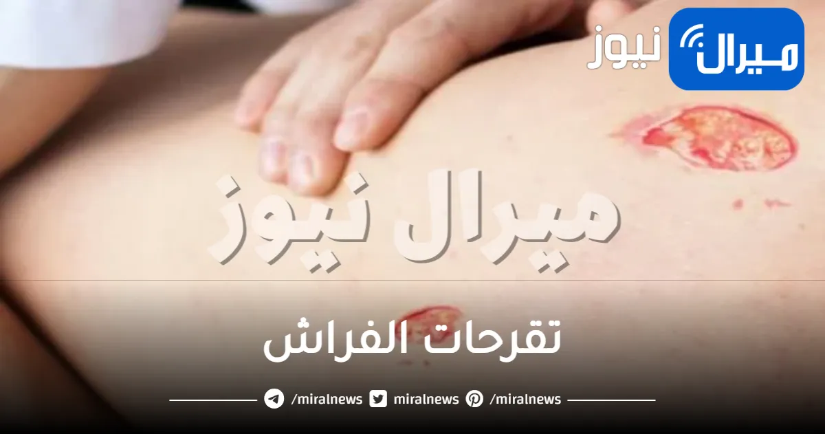 علاج مجرب لتقرحات الفراش بالأعشاب والوصفات الطبيعية