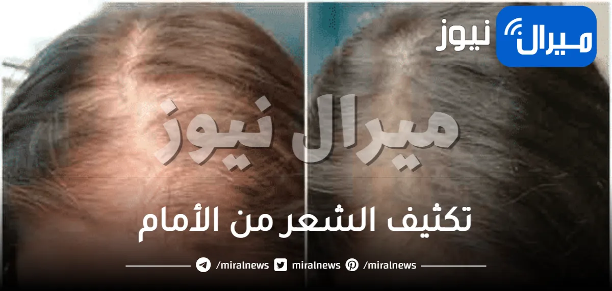 وصفة لتكثيف الشعر .. تكثيف الشعر من الأمام