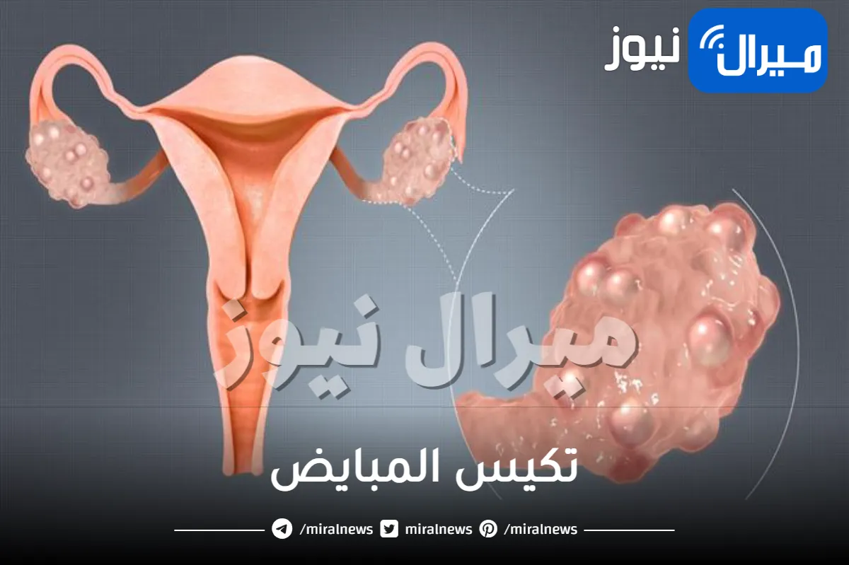 تكيس المبايض والأعراض والأسباب وكيفية علاجه