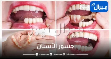 جسور الأسنان