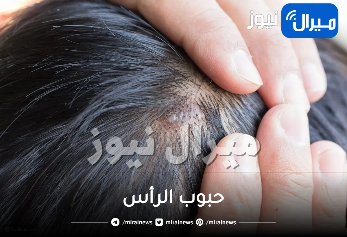 حبوب الرأس .. أسباب ظهورها وأفضل طرق علاجها