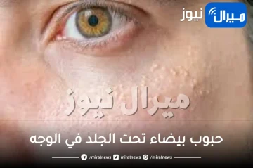 علاج حبوب بيضاء تحت الجلد في الوجه