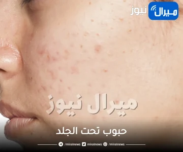 علاج الحبوب تحت الجلد