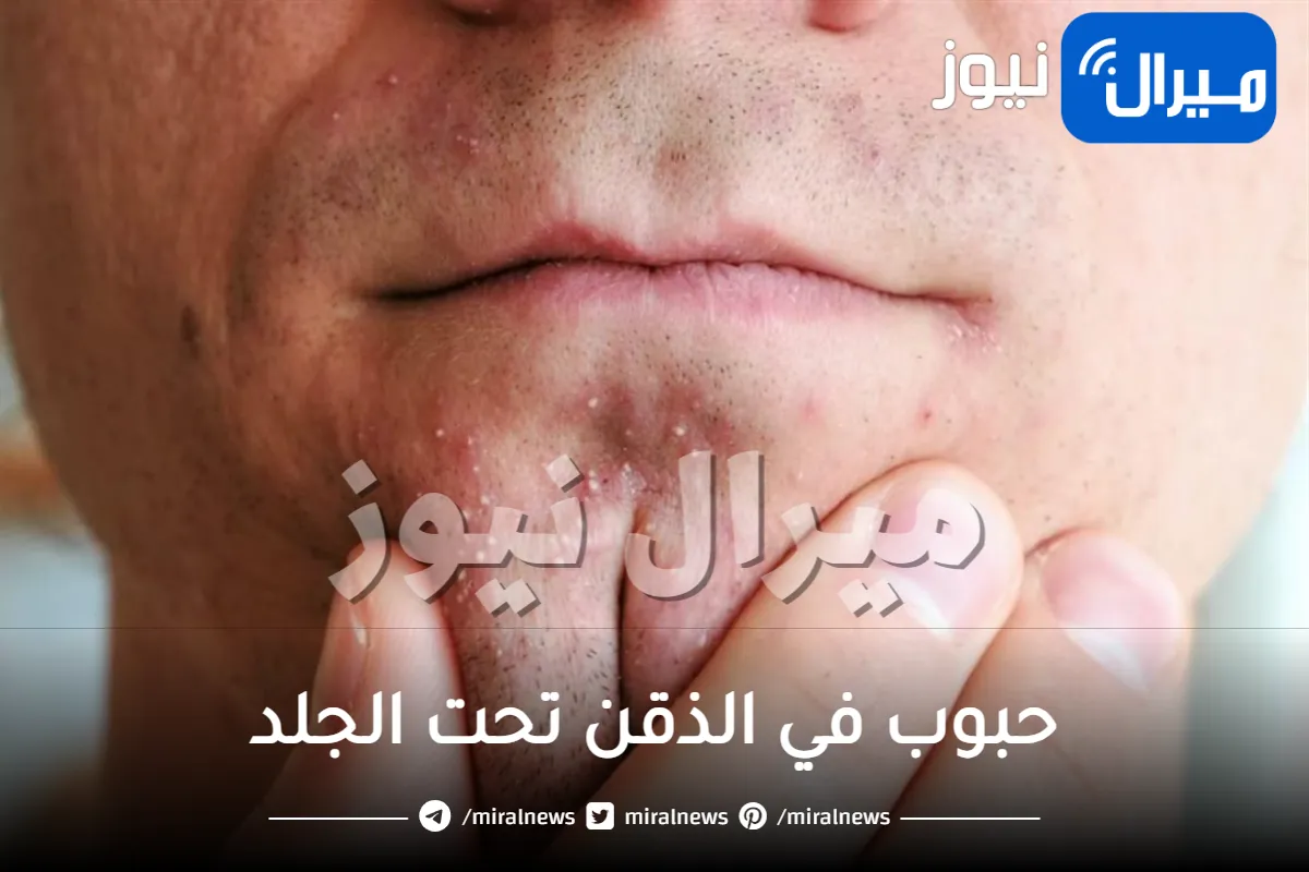حبوب في الذقن تحت الجلد .. اسبابها وطرق التخلص منها