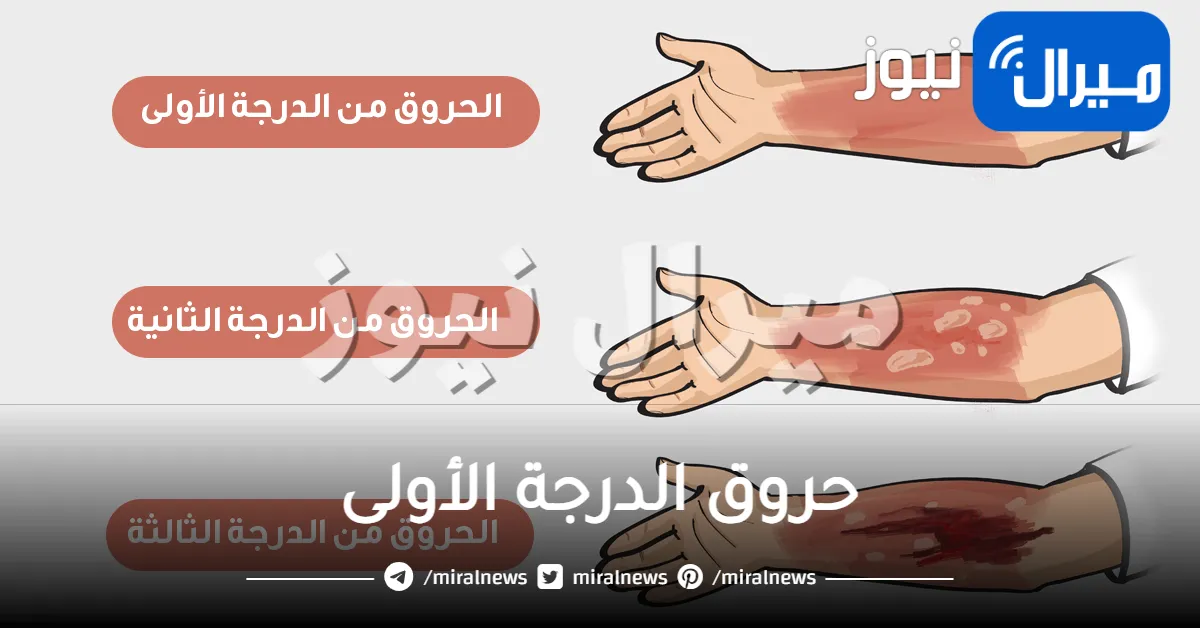 حروق الدرجة الأولى