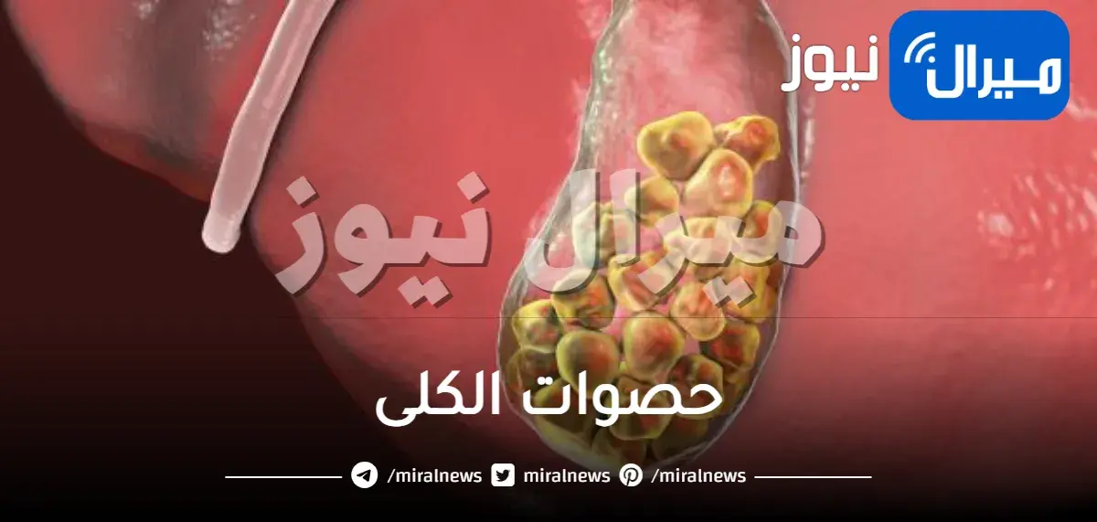 حصوات الكلى