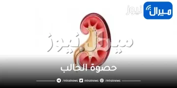 حصوة الحالب