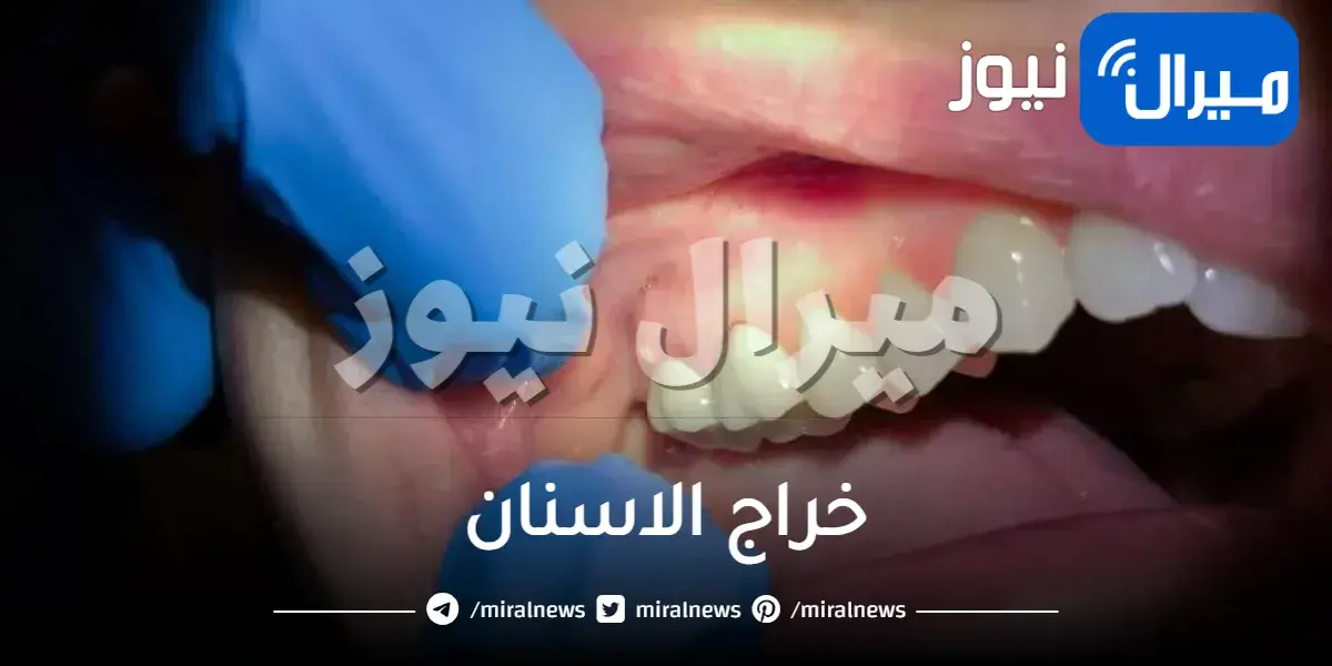 خراج الاسنان وكيفية علاجه