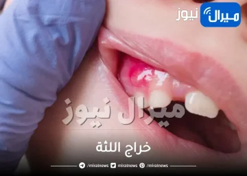 خراج اللثة وعلاجها