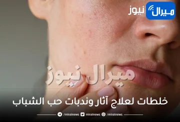 10 خلطات لعلاج آثار وندبات حب الشباب