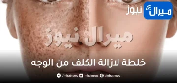 خلطة لازالة الكلف من الوجه