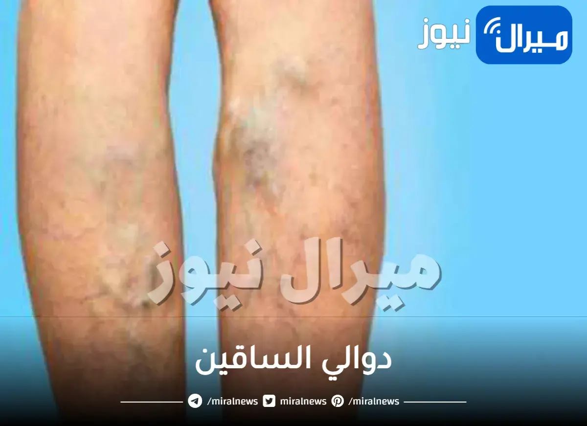 دوالي الساقين