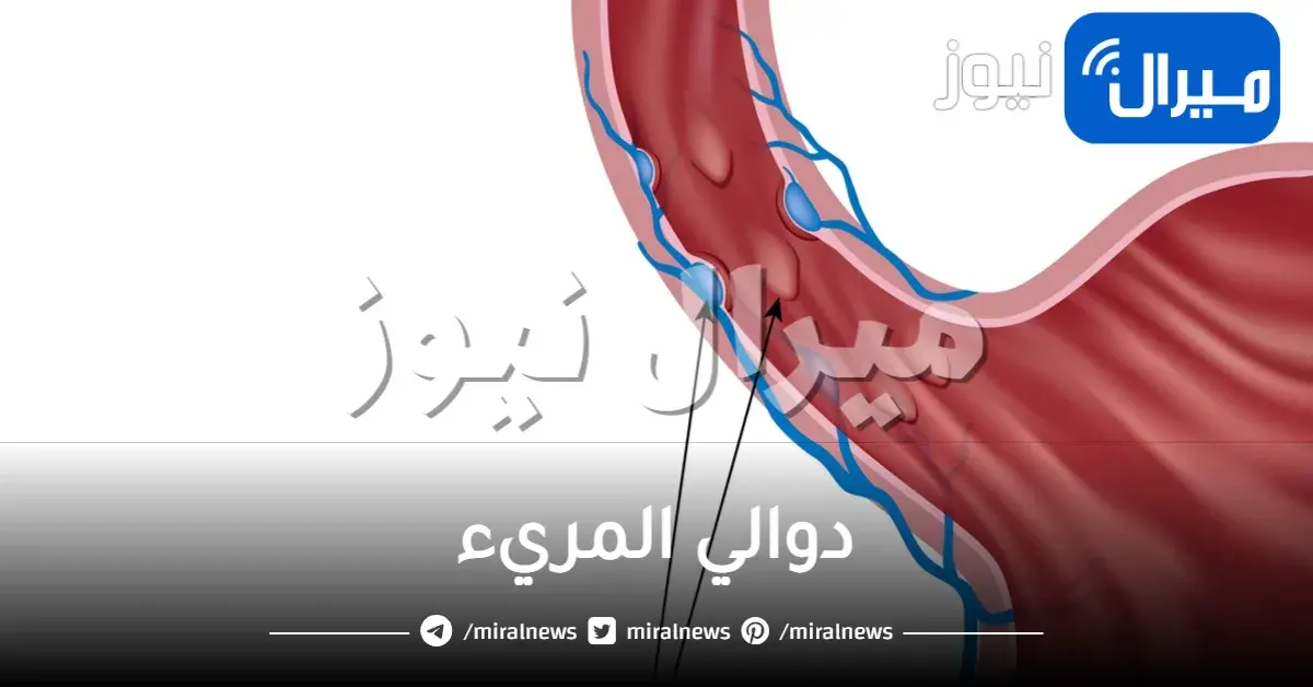 دوالي المريء اعراضه واسبابه وعلاجه