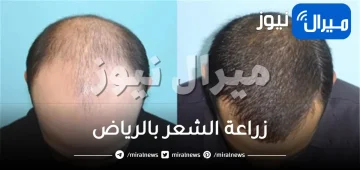 زراعة الشعر بالرياض