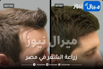 زراعة الشعر في مصر