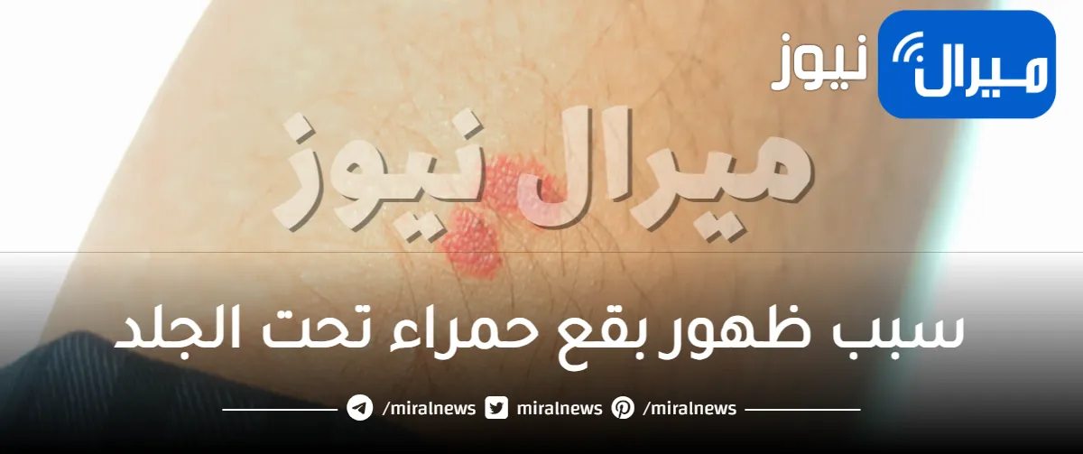 سبب ظهور بقع حمراء تحت الجلد وكيفية علاجها بالأعشاب في 7 خطوات تجربتي