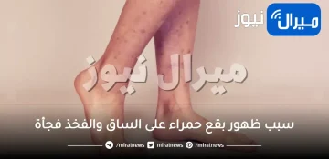 سبب ظهور بقع حمراء على الساق والفخذ فجأة
