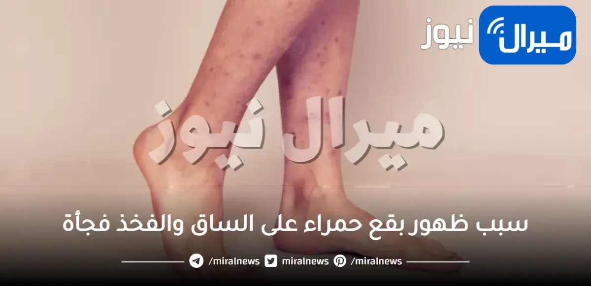 سبب ظهور بقع حمراء على الساق والفخذ فجأة