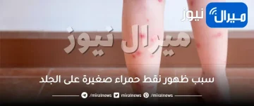 سبب ظهور نقط حمراء صغيرة على الجلد فجأة بدون حكة للأطفال