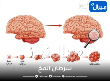 سرطان المخ واعراضه واسبابه ونوعه الخبيث