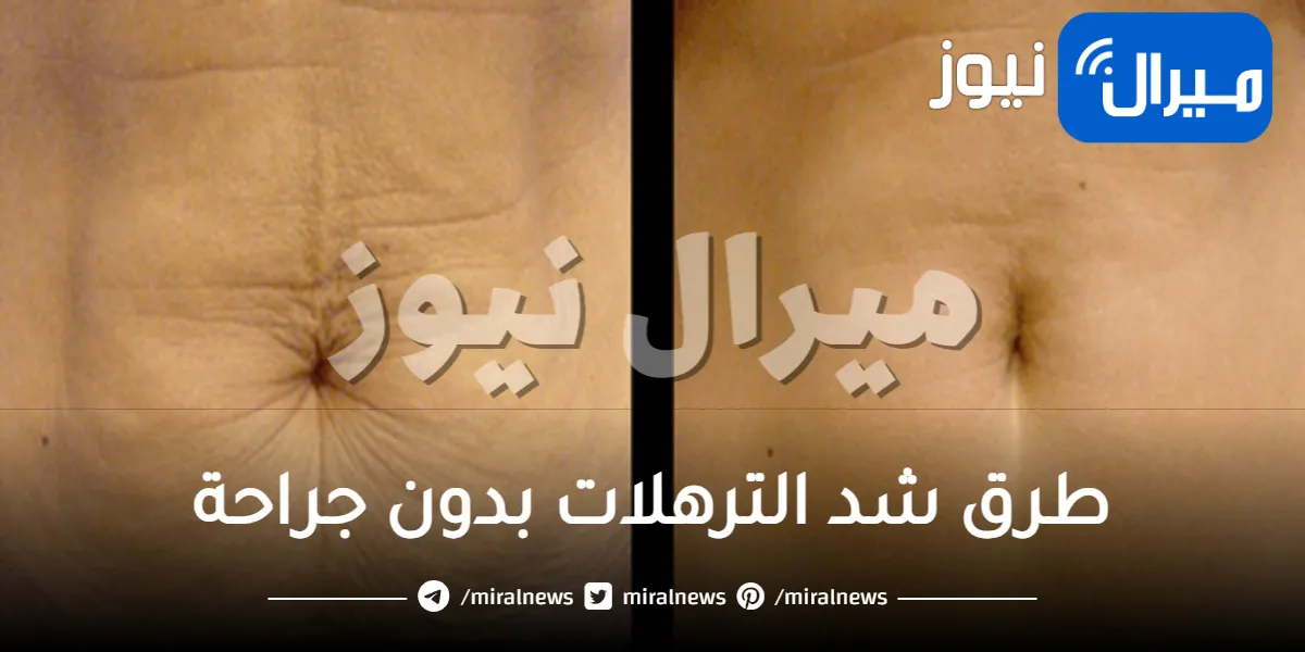 طرق شد الترهلات بدون جراحة