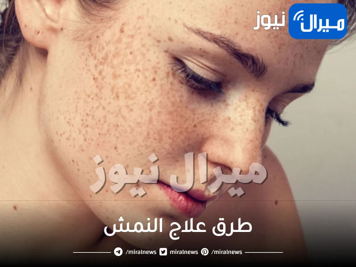 طرق علاج النمش طبيا