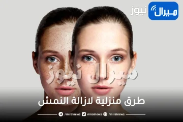 19 وصفة طبيعية لعلاج النمش نهائيا