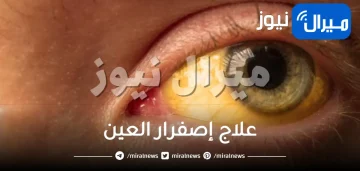 علاج إصفرار العين .. طرق سحرية لعلاج إصفرار العين