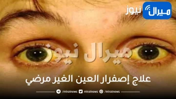 علاج إصفرار العين الغير مرضي بطرق سهلة ونصائح للوقاية منه