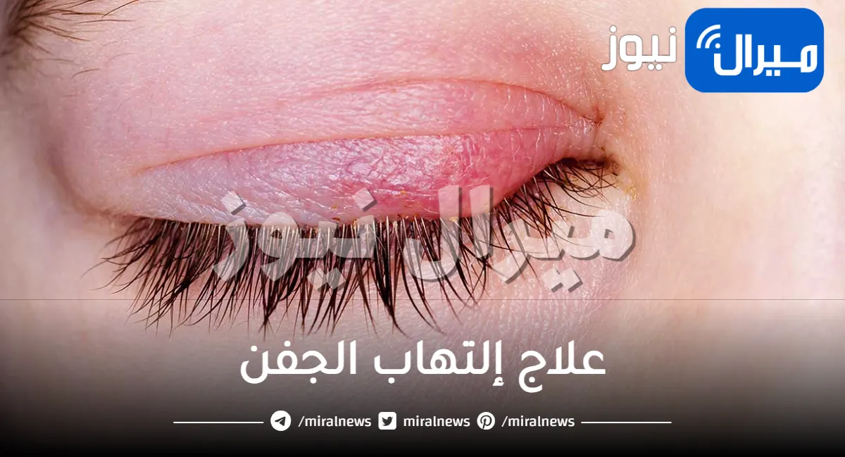 علاج التهاب العين