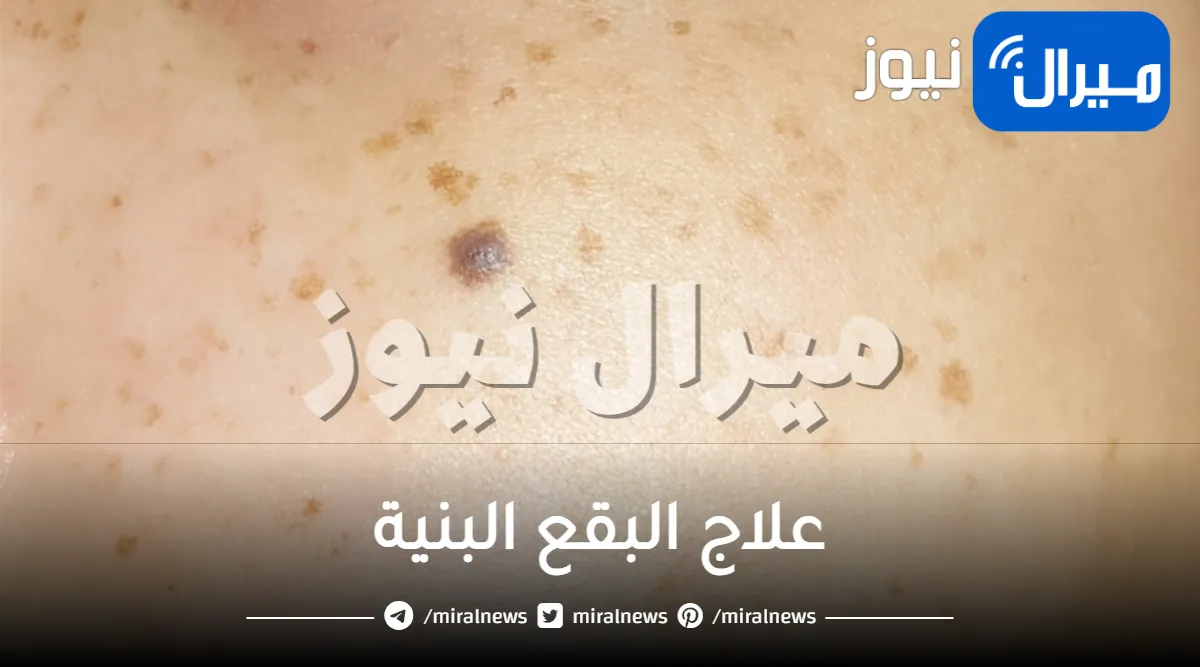 علاج البقع البنية في الوجه والجسم