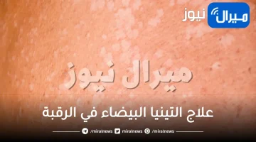علاج التينيا البيضاء في الرقبة