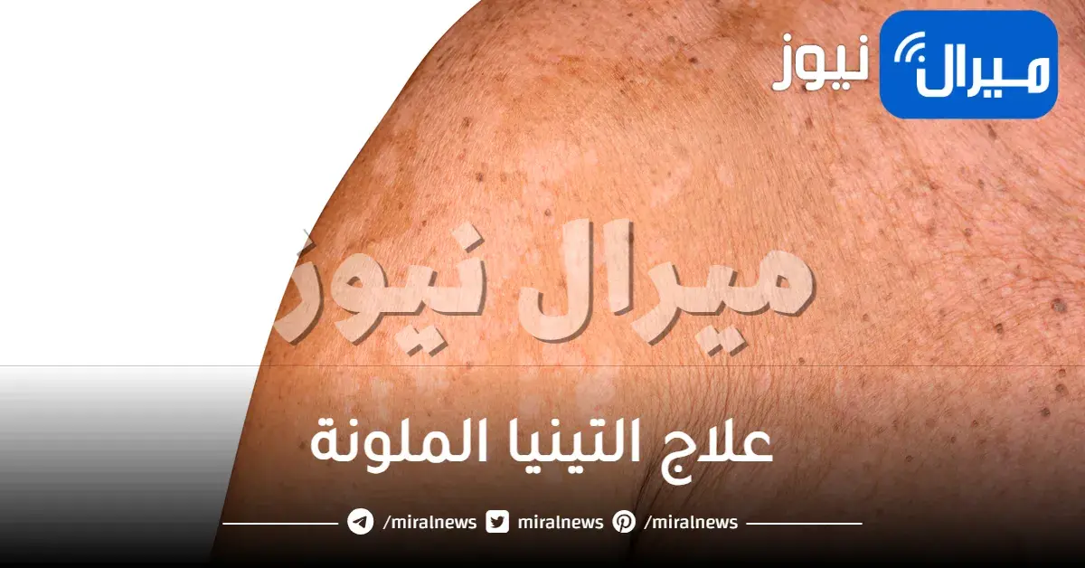 علاج التينيا الملونة بالاعشاب و علاج التينيا الملونة بالخل