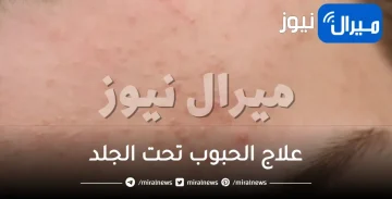 علاج الحبوب تحت الجلد.. وكيفية التخلص منها