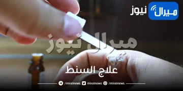 علاج السنط