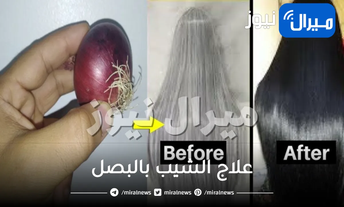 علاج الشيب بالبصل