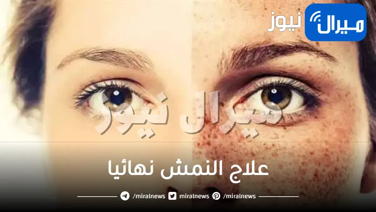 علاج النمش نهائيا وبطريقة مجربة