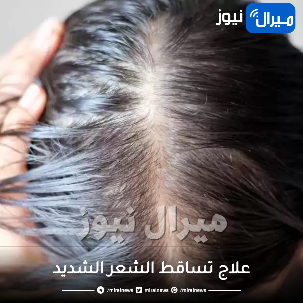 علاج تساقط الشعر الشديد