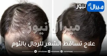 علاج تساقط الشعر للرجال بالثوم